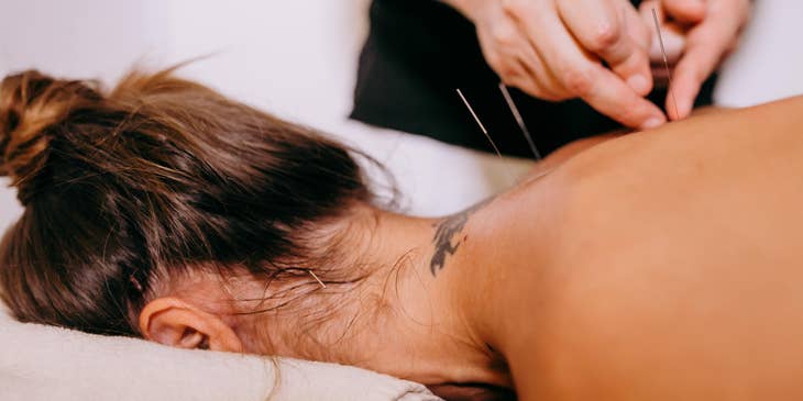 Acupuncturist treating the patient with the use of Acupuncture needles.